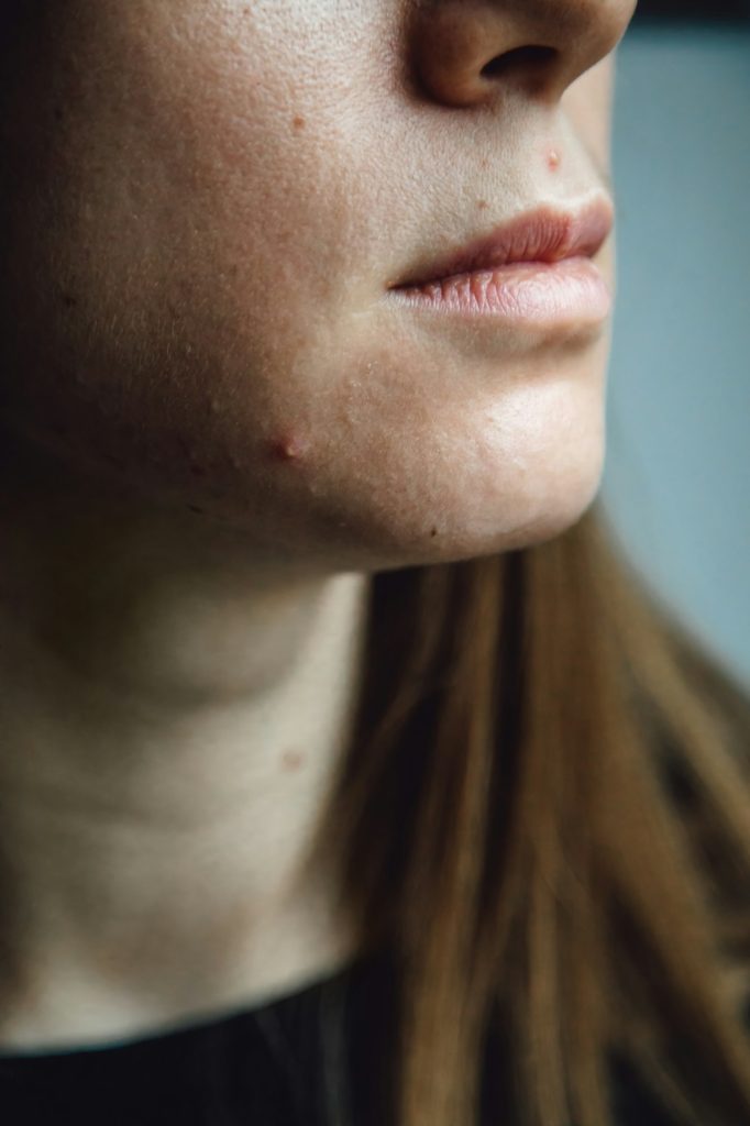 Close up of young woman having acne and pimples on unhealthy skin. Anxious woman worried about